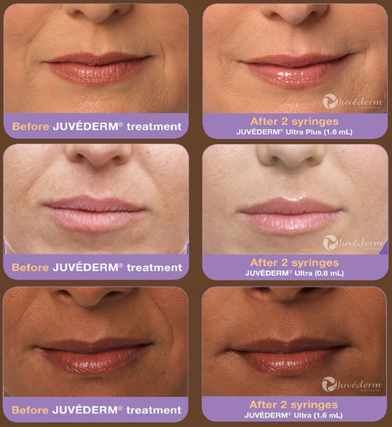 Стеллаж для губ отзывы. Juvederm Ultra smile, Juvederm Ultra 3. Juvederm Ultra smile плотность. Препарат Ювидерм 3 для губ 1 мл. Juvederm Ultra smile 0.5.