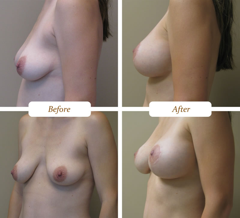 breast-lift-procedure