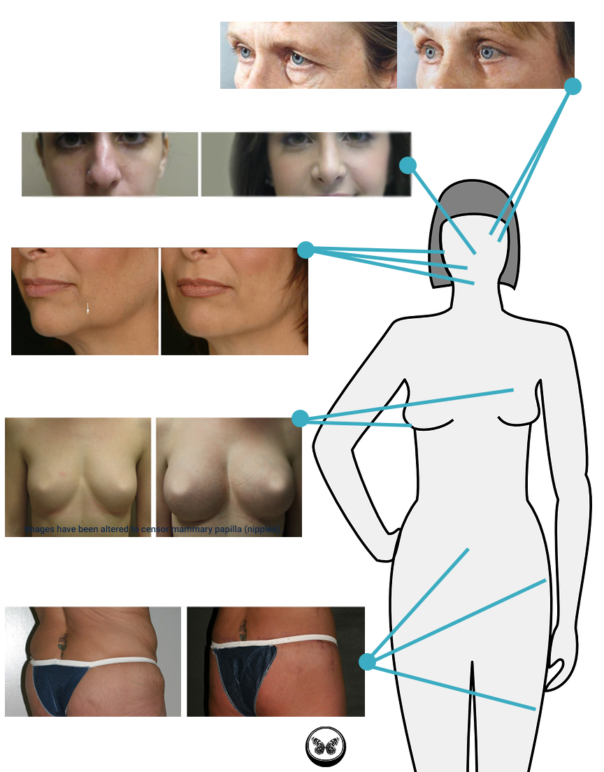 5 Reasons to Consider Liposuction: Cosmetic Surgery Center