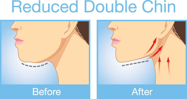 Illustration of neck lift and face lift before and after cosmetic procedure.