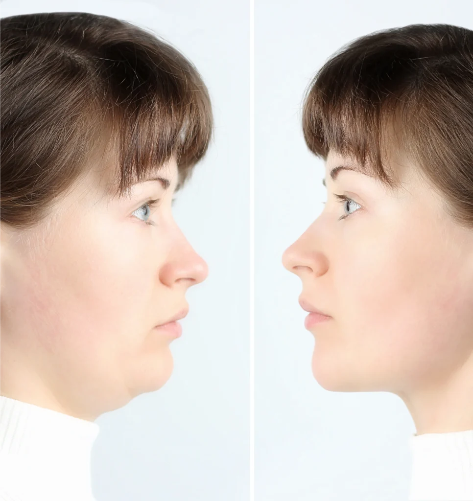 Kybella – Ballantyne Plastic Surgery